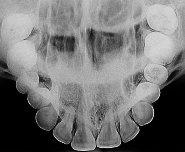 Oclusal