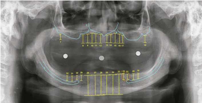 Panorâmica para implantes