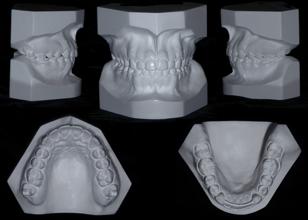 Modelos Ortodônticos
